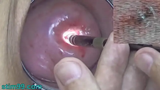 Doctor Gynecologist Inspects My Cervix &mdash;  Womb &mdash;  and Vagina🌮️ with Endoscope